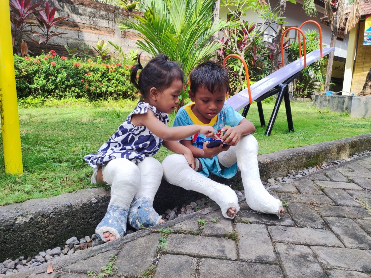 Twee kinderen uit Indonesië die behandeld worden voor klompvoeten.